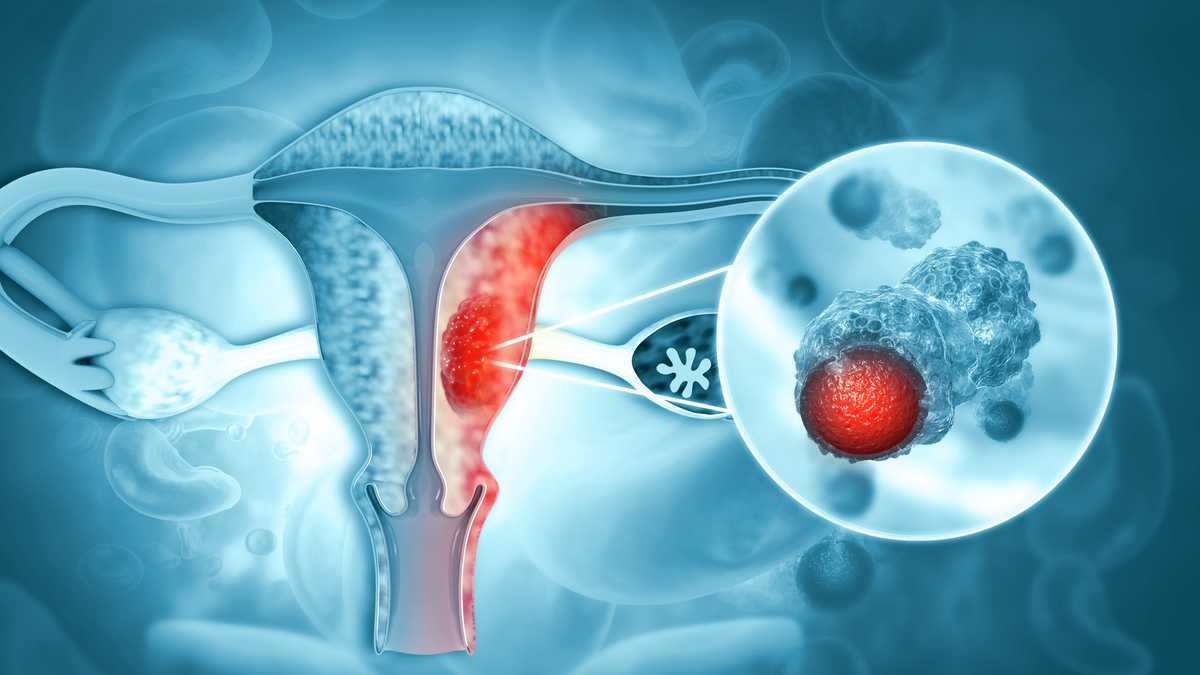 imagen de cancer de cuello uterino