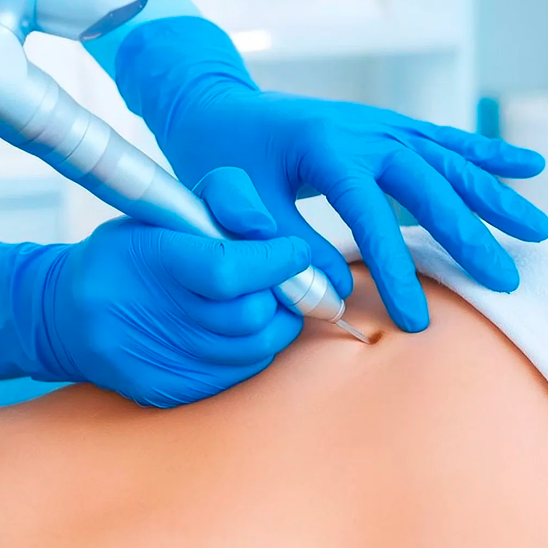 Eliminación de verrugas