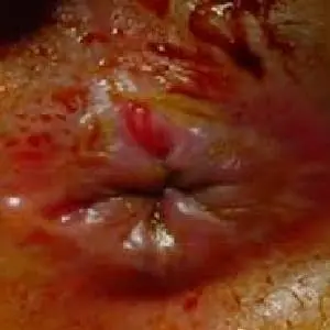 Esquema Cáncer Ano