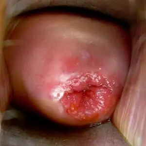 Esquema Cuello Uterino