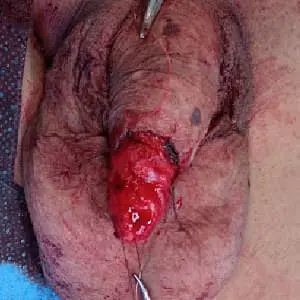 Esquema Cáncer Pene